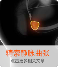 精索静脉曲张